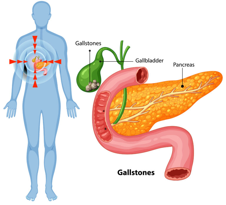 gallstones นิ่วในถุงน้ำดี