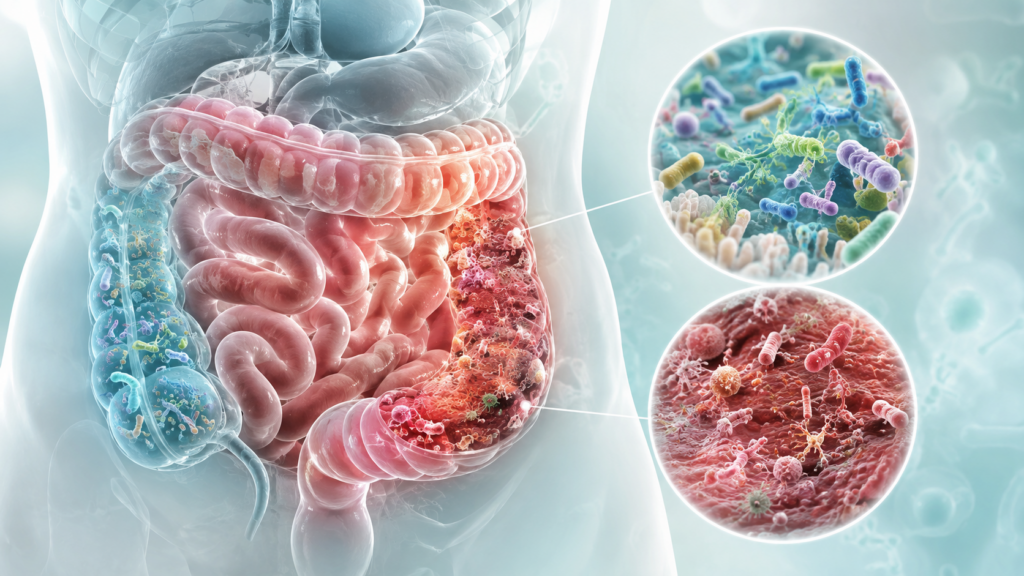 Gut Dysbiosis