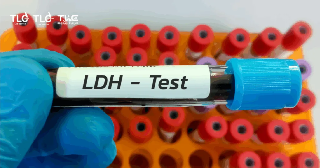 Lactate Dehydrogenase (LDH)