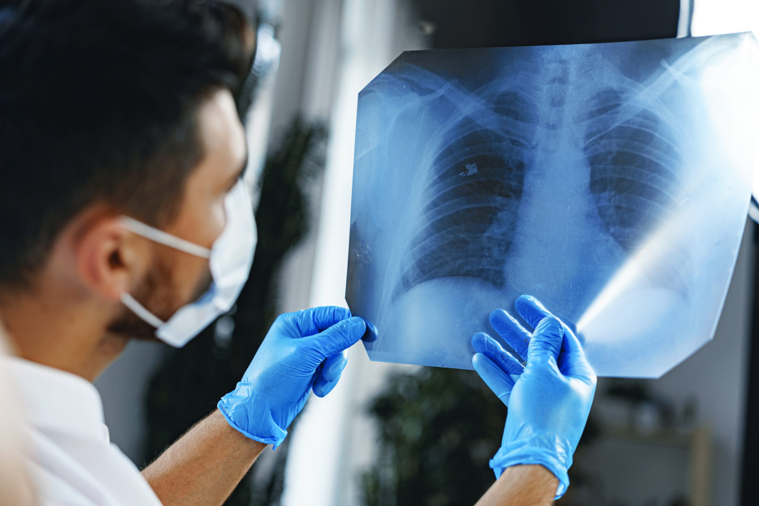 มะเร็งปอด - lung cancer