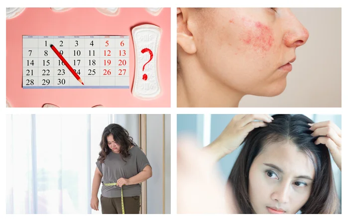 ถุงน้ำในรังไข่ หลายใบ - PCOS (Polycystic Ovary Syndrome)