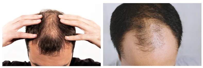 ผมร่วง ใน ผู้ชาย - hair loss in men